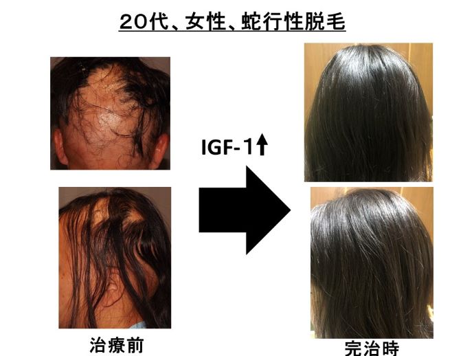 え円形脱毛症　病院